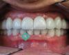 A-Implant Dental Laboratory Inc