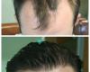 Biltmore Surgical Hair Restoration