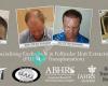 Carolina Hair Surgery: FUE Neograft