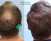 Carolina Hair Surgery: Michael W. Vories, MD