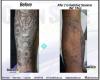 Clean Slate Laser Tattoo Removal - Manhattan