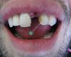 Dental Implants Hawaii