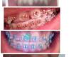 Diamond Braces