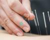 Frank Muscara Acupuncture