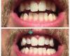 Glow Teeth Whitening